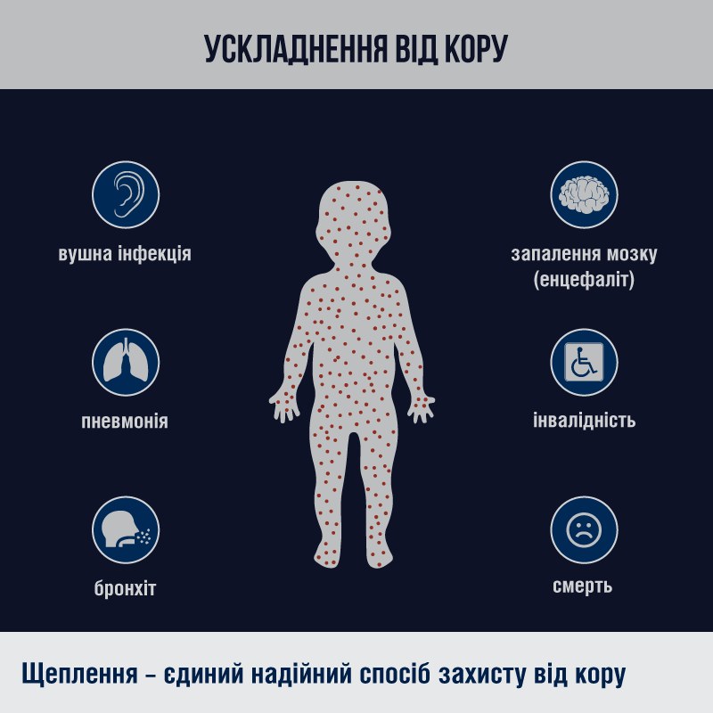 Ще понад три тисячі українців захворіли на кір минулого тижня — захистити від хвороби може лише вакцинація